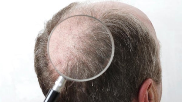 טיפול בנשירת שיער גברים